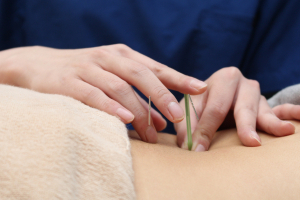 南行徳鍼灸整骨院の鍼灸施術の施術風景画像です。