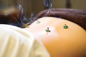 あかさか二丁目接骨院の灸の施術風景画像です。