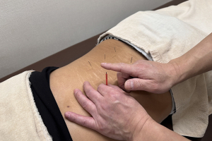 小林整骨院・はりきゅう院　三ノ輪院のぎっくり腰に対する施術風景画像です。