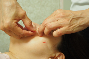 渡辺治療院の鍼灸施術の画像