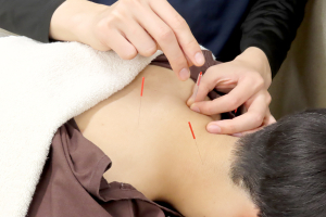 千歳烏山駅前鍼灸院・整骨院の鍼の施術風景画像です。