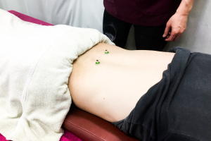 五健鍼灸整骨院　世田谷本院の鍼灸施術の画像