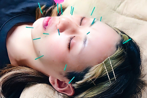 五健鍼灸整骨院　世田谷本院の美容鍼施術の画像