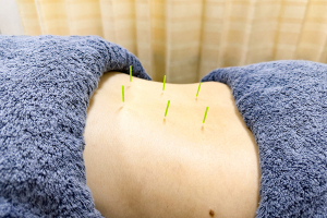 笹塚　せせらぎ整骨院の鍼灸施術の画像