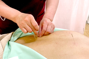 健康堂接骨鍼灸マッサージ院の鍼灸施術の施術風景画像です。