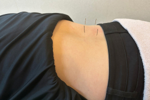 長者町ビオス整骨院の鍼灸施術の施術風景画像です。