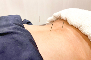 さくら鍼灸接骨院　大船院の鍼灸の施術画像