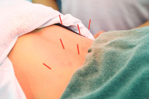 トレス鍼灸接骨院　相模店の鍼灸施術の画像