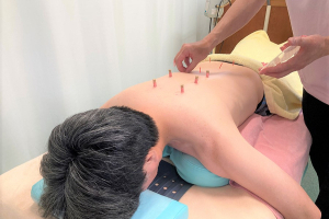 田子浦鍼灸接骨院の鍼灸施術の画像