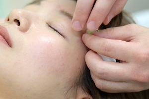 げんき鍼灸整骨院の鍼灸施術の画像