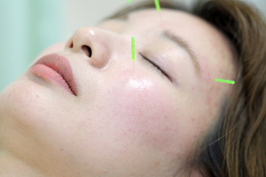 げんき鍼灸整骨院の美容鍼の施術画像