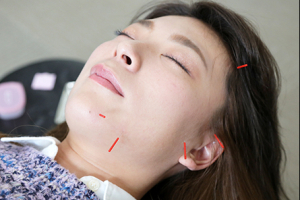 もりわき鍼灸整骨院 上新庄院の美容鍼施術の画像