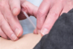 禄山鍼灸治療院の鍼灸施術の画像