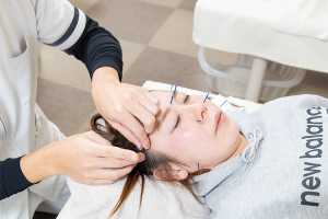 もりおか鍼灸整骨院枚方御殿山院の美容鍼施術画像