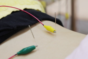 八尾市たんぽぽ鍼灸整骨院の鍼灸施術の画像