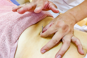 みやざき鍼灸整骨院　河内花園院の鍼灸施術の施術風景画像です。