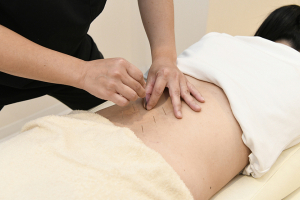 たくみ整骨院　塚口本町院【鍼灸】の鍼灸の施術画像