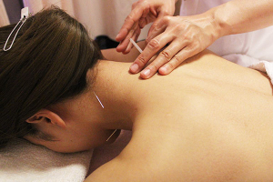 はるみ鍼灸治療院の肩こりの施術風景画像です。