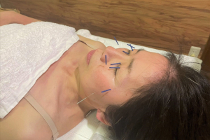 いしだ鍼灸院の鍼灸施術の画像