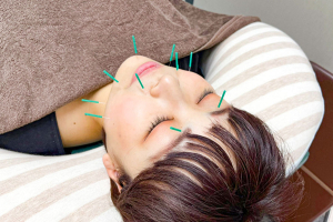 堺整骨院　大橋院の鍼灸施術の施術風景画像です。