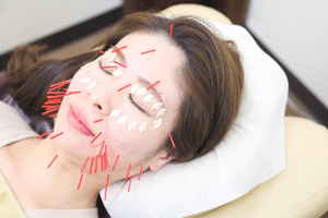 ひだまり鍼灸院整骨院の美容鍼の施術画像