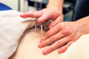 あさひが丘接骨院の鍼灸施術の施術風景画像です。