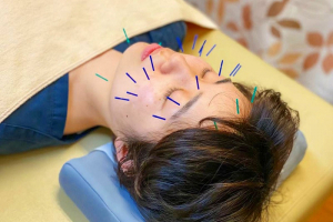 あさひが丘接骨院の美容鍼の施術風景画像です。