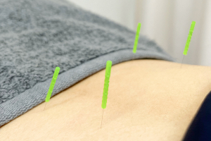 こもれび鍼灸整骨院の鍼灸の施術画像