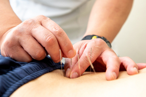 いいな鍼灸整骨院の鍼灸施術の画像