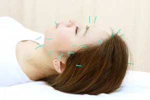 健志整骨院十三院の鍼灸施術の画像