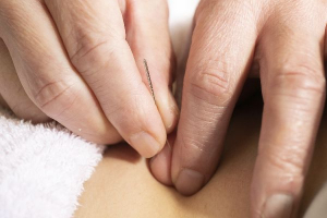 城野接骨院の鍼灸施術の画像