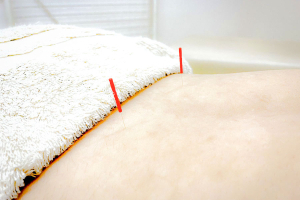 湯川鍼灸整骨院　安部山院の鍼灸の施術風景画像