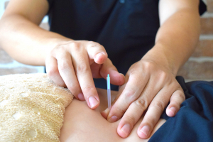 和幸はり灸整骨院の鍼灸施術の画像