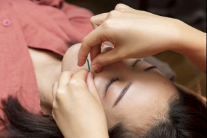 mana整骨院の鍼灸施術の画像