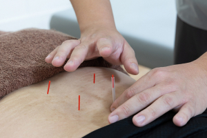 あい鍼灸院・接骨院　谷６院の鍼灸施術の施術風景画像です。