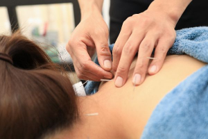 吉祥寺　みやま鍼灸院の鍼灸施術の画像
