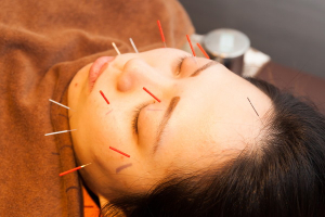 もりわき鍼灸整骨院 江坂院の美容鍼施術の画像