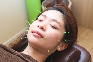 てらす鍼灸整骨院の美容鍼の施術画像