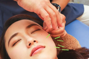 治療院　神楽の美容鍼施術の画像