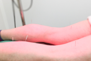 ケイはり灸治療院の鍼灸施術の画像