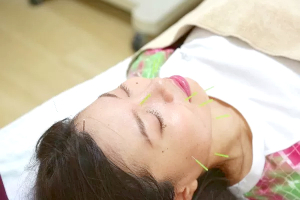 みうら鍼灸整骨院の美容鍼の施術画像