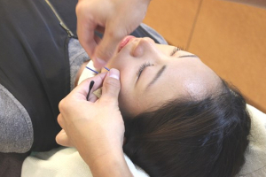 SUN鍼灸整骨院の美容鍼施術の画像