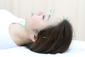 はりきゅう整骨院　健志（旧：健志整骨院　西中島院）の鍼灸の施術画像