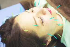 はり灸マッサージ院　ｗｉｔｈ　ＥＡＲＴＨの美容鍼施術の画像