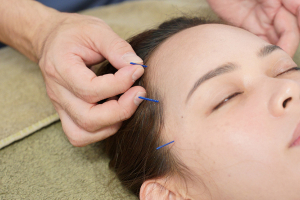 横浜みなと鍼灸院整骨院の美容鍼施術の施術風景画像です。