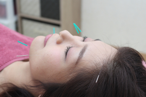 鍼灸マッサージ治療院すきっぷの美容鍼の施術風景画像