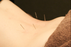 草加べんてん接骨院 鍼灸院の鍼灸施術の画像