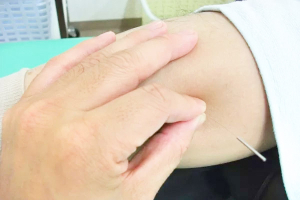 あおぞら鍼灸接骨院の鍼灸施術の画像