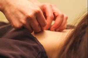 鍼灸あんまマッサージ指圧 ひとみ治療院の肩こりの施術画像