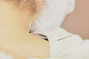 かみなかひかり鍼灸院接骨院の鍼灸施術の画像